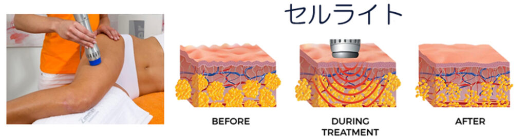 浅層筋膜へのアプローチでセルライト除去にも応用