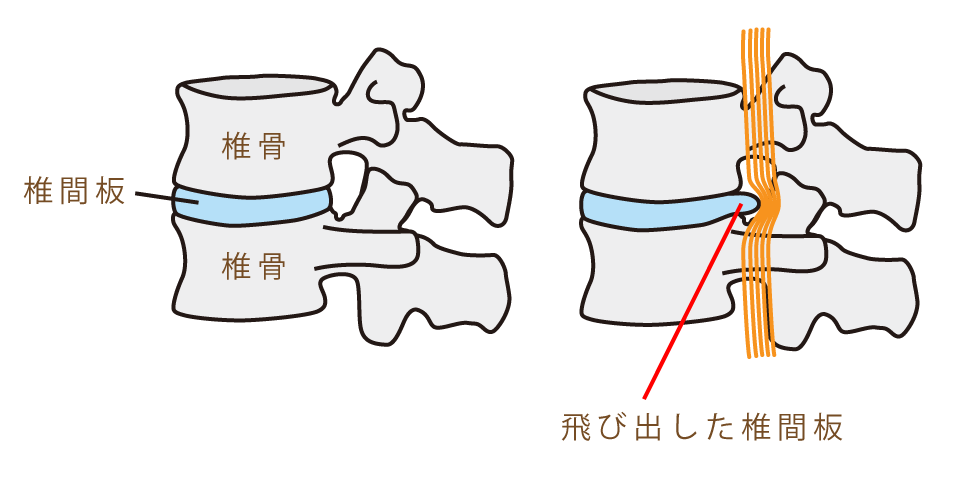 ヘルニアの原因